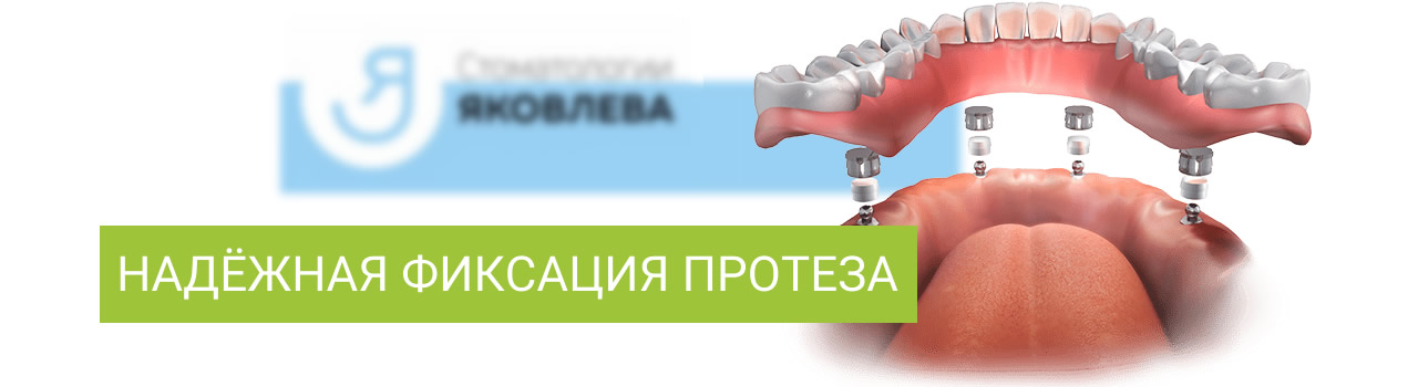 Имплантация зубов в Красноярске