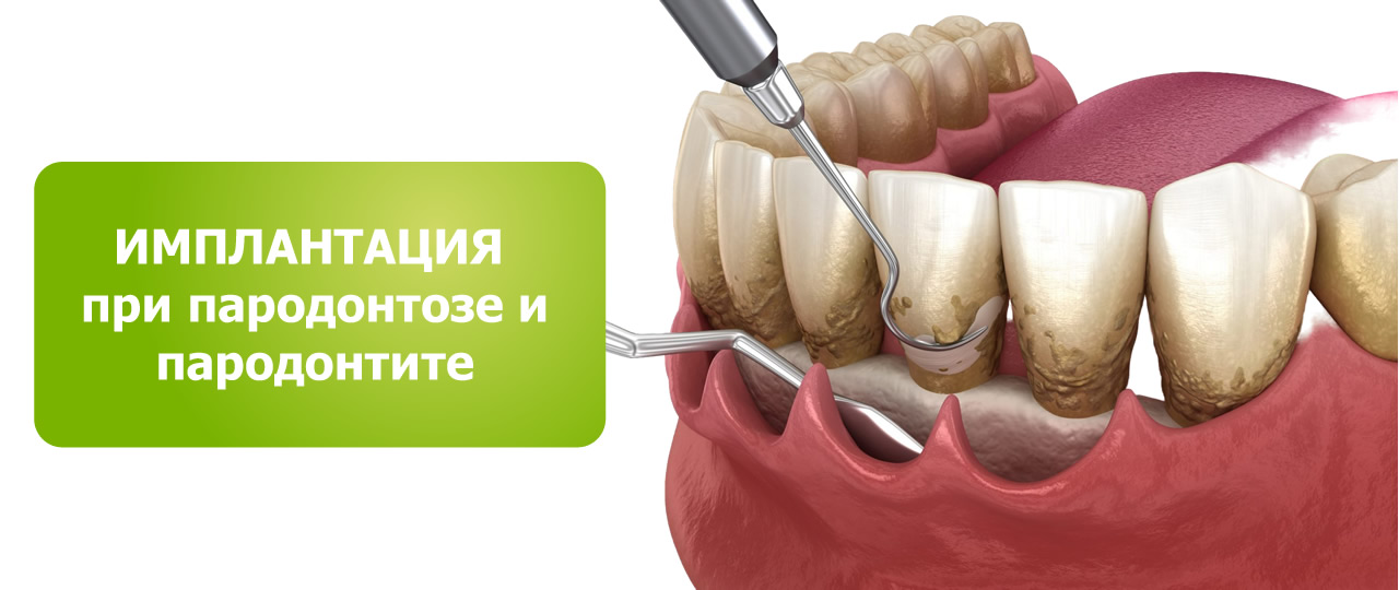 Имплантация зубов при пародонтозе и пародонтите в Красноярске